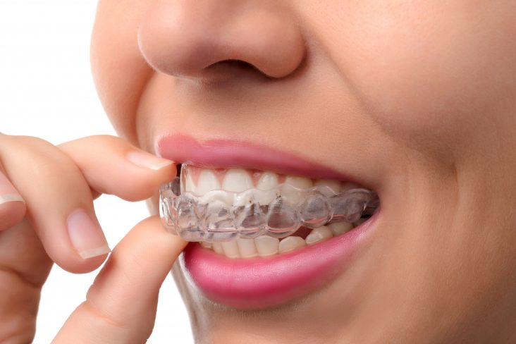 Candidate for Invisalign