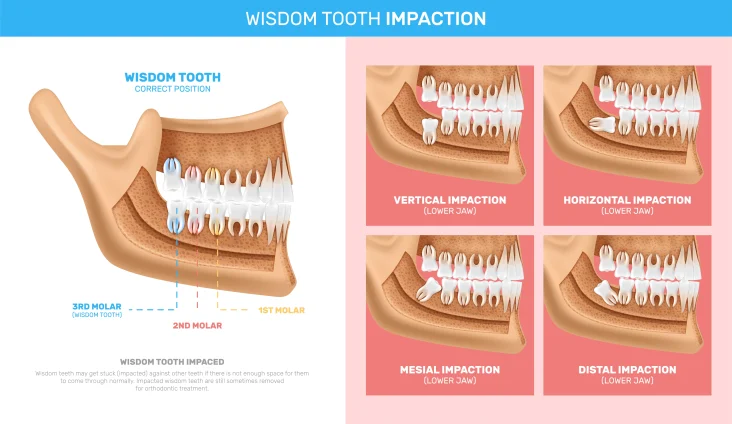Impacted wisdom tooth