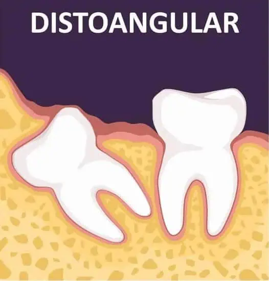 Distal Impaction