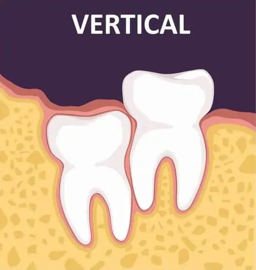 Vertical Impaction