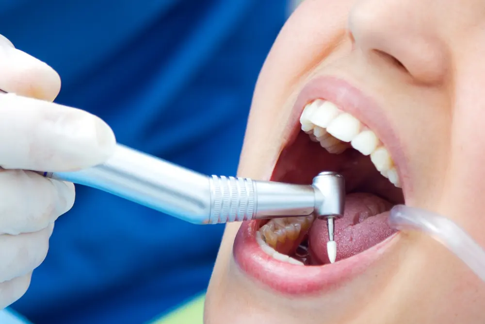 Dental Polishing