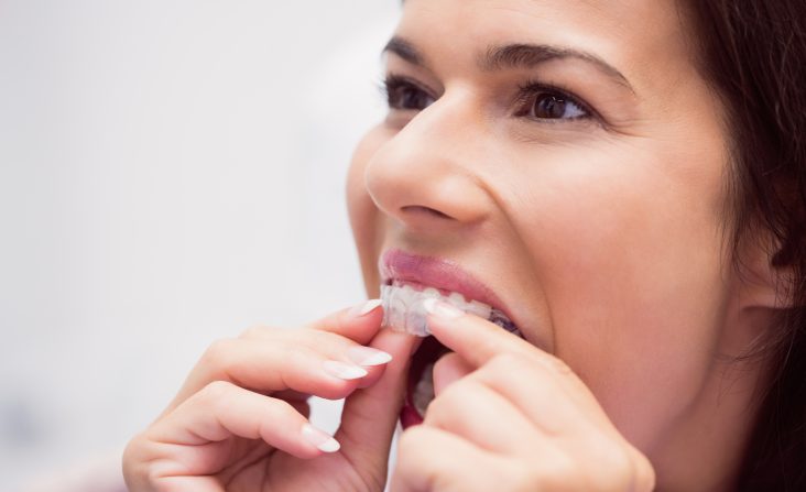 Female wearing Invisalign