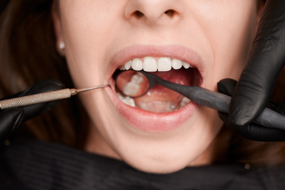 Dental Tartar